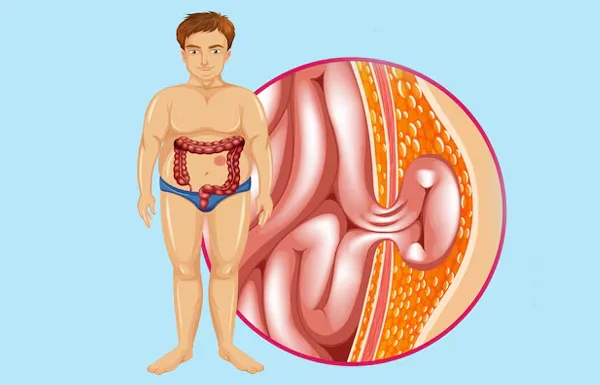 Groin Hernia Surgery