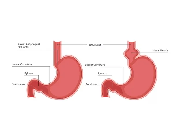 Hiatus Hernia Surgery