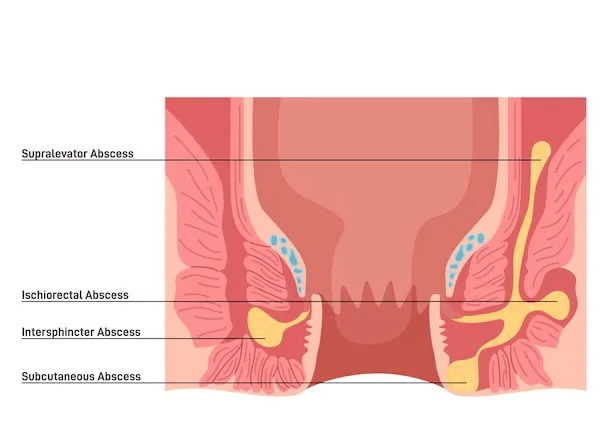 Perianal Abscess Surgery