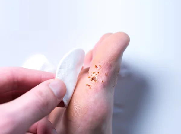 Wart Laser Ablation