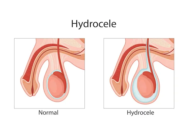 Hydrocele Surgery