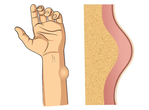 Lipoma Surgery
