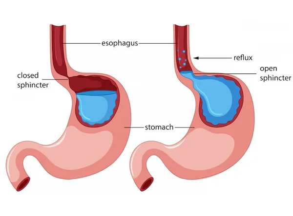 Gastroesophageal Reflux Treatment